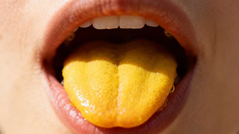 Piel amarillenta en la lengua: lo que podría estar revelando sobre tu salud